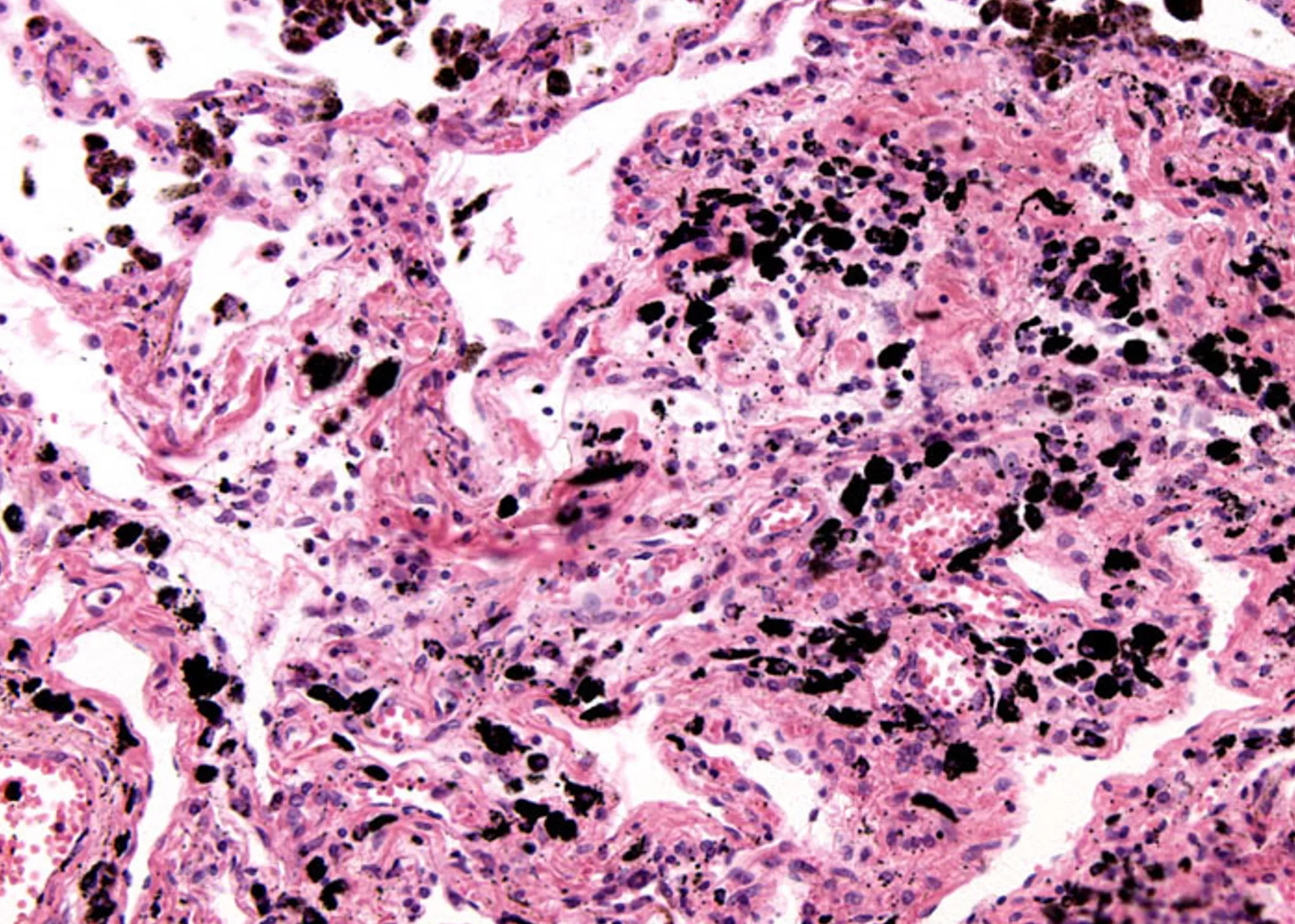 H&E-stained lung tissue slide showing anthracotic pigment deposits